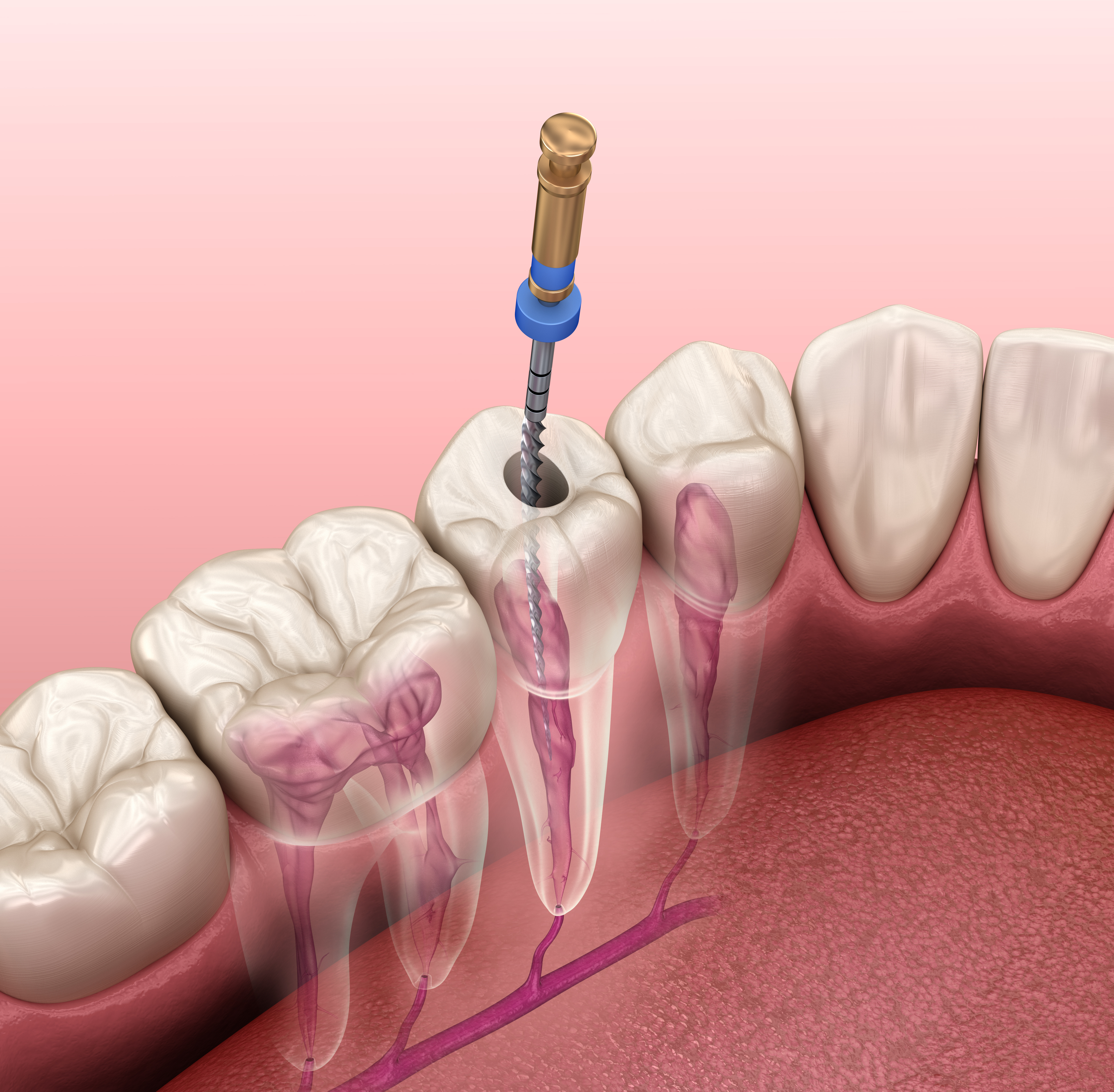 Treatment of tooth and removal nerve 3d illustration (5).jpg